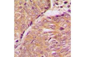 Immunohistochemical analysis of STMN1 staining in human breast cancer formalin fixed paraffin embedded tissue section. (Stathmin 1 抗体  (N-Term))