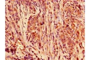 Immunohistochemistry of paraffin-embedded human pancreatic cancer using ABIN7150430 at dilution of 1:100 (POLR2C 抗体  (AA 2-275))