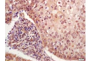 Formalin-fixed and paraffin embedded human laryngocarcinoma labeled with Anti-phospho-P53(Ser33) Polyclonal Antibody, Unconjugated (ABIN702925) at 1:200 followed by conjugation to the secondary antibody and DAB staining (p53 抗体  (pSer33))