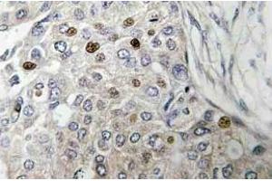 Immunohistochemistry (IHC) analyzes of p53 antibody in paraffin-embedded human breast carcinoma tissue. (p53 抗体)