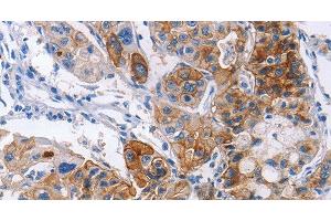 Immunohistochemistry of paraffin-embedded Human lung cancer using CD54 Polyclonal Antibody at dilution of 1:30 (ICAM1 抗体)
