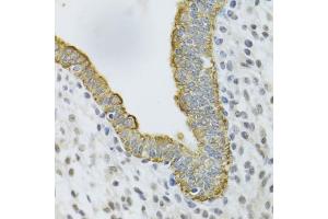 Immunohistochemistry of paraffin-embedded human uterine cancer using KRT5 Antibody (ABIN5971441) at dilution of 1/100 (40x lens). (Cytokeratin 5 抗体)