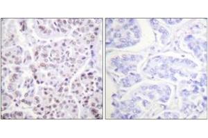 Immunohistochemistry analysis of paraffin-embedded human breast carcinoma tissue, using Histone H4 (Acetyl-Lys5) Antibody. (Histone H4 抗体  (acLys5))