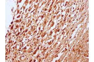 IHC image of ABIN7127796 diluted at 1:100 and staining in paraffin-embedded human melanoma cancer performed on a Leica BondTM system. (Recombinant RNF2 抗体)