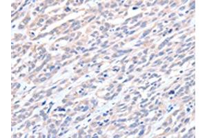 The image on the left is immunohistochemistry of paraffin-embedded Human esophagus cancer tissue using ABIN7128194(ACTL8 Antibody) at dilution 1/15, on the right is treated with fusion protein. (Actin-Like 8 抗体)