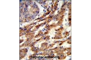 Formalin-fixed and paraffin-embedded human hepatocarcinoma reacted with ERGIC3 Antibody (N-term), which was peroxidase-conjugated to the secondary antibody, followed by DAB staining. (ERGIC3 抗体  (N-Term))