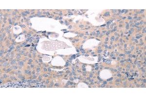 Immunohistochemistry of paraffin-embedded Human cervical cancer tissue using ABCF1 Polyclonal Antibody at dilution 1:40 (ABCF1 抗体)