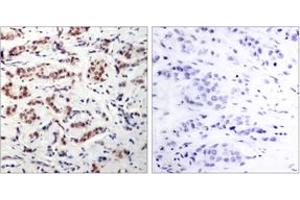Immunohistochemistry analysis of paraffin-embedded human breast carcinoma, using STAT5A (Phospho-Tyr694) Antibody. (STAT5A 抗体  (pTyr694))