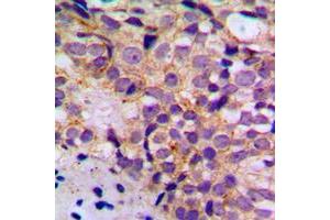 Immunohistochemical analysis of BIM (pS69) staining in human breast cancer formalin fixed paraffin embedded tissue section. (BIM 抗体  (pSer69))