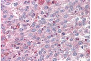 Anti-KLF4 antibody IHC staining of human melanoma. (KLF4 抗体  (AA 80-129))