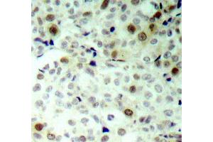 Immunohistochemistry of paraffin-embedded human breast carcinoma using Phospho-CDK2-T160 antibody (ABIN2987938). (CDK2 抗体  (pThr160))