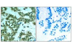 Immunohistochemical analysis of paraffin-embedded human lung carcinoma tissue using PKCth(Phospho-Ser676) Antibody(left) or the same antibody preincubated with blocking peptide(right). (PKC theta 抗体  (pSer676))