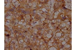 IHC image of ABIN7127636 diluted at 1:100 and staining in paraffin-embedded human liver cancer performed on a Leica BondTM system. (Recombinant N-Cadherin 抗体)