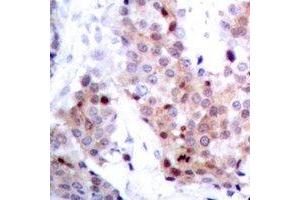 Immunohistochemical analysis of p53 staining in human breast cancer formalin fixed paraffin embedded tissue section. (p53 抗体)