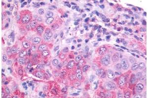 Anti-NMBR antibody IHC staining of human lung, carcinoma. (NMBR 抗体  (Cytoplasmic Domain))