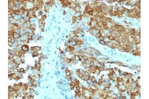 Formalin-fixed, paraffin-embedded human Melanoma stained with gp100 Mouse Monoclonal Antibody (PMEL/2038). (Melanoma gp100 抗体  (AA 376-502))