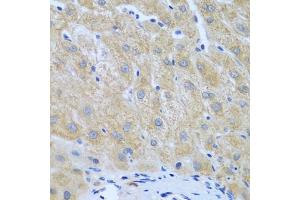 Immunohistochemistry of paraffin-embedded human liver cancer using FURIN antibody (ABIN5974735) at dilution of 1/100 (40x lens). (FURIN 抗体)