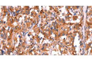 Immunohistochemistry of paraffin-embedded Human thyroid cancer tissue using GCG Polyclonal Antibody at dilution 1:40 (Glucagon 抗体)