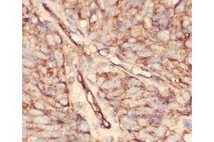IHC-P: CD34 antibody testing of human lung cancer tissue (CD34 抗体  (AA 151-385))