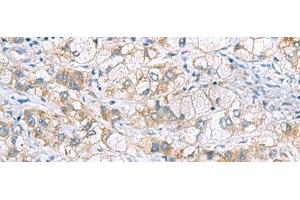 Immunohistochemistry of paraffin-embedded Human liver cancer tissue using GCSH Polyclonal Antibody at dilution of 1:60(x200) (GCSH 抗体)