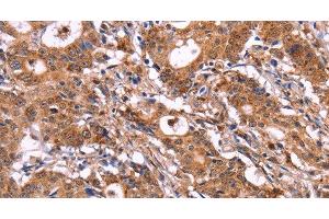 Immunohistochemistry of paraffin-embedded Human gastic cancer using SIGLEC5 Polyclonal Antibody at dilution of 1:30 (SIGLEC5 抗体)