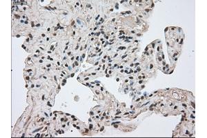 Immunohistochemical staining of paraffin-embedded Adenocarcinoma of breast tissue using anti-FERMT2 mouse monoclonal antibody. (FERMT2 抗体)