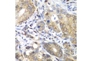 Immunohistochemistry of paraffin-embedded human gastric cancer using CDK1 antibody (ABIN6134274, ABIN6138303, ABIN6138304 and ABIN6219543) at dilution of 1:100 (40x lens). (CDK1 抗体  (AA 208-258))