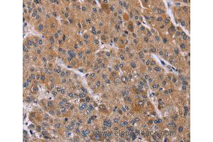 Immunohistochemistry of Human liver cancer using PPIF Polyclonal Antibody at dilution of 1:45 (PPIF 抗体)