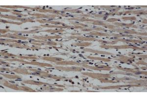 Immunohistochemistry of paraffin-embedded Human gasrtic cancer tissue using NOS2 Polyclonal Antibody at dilution 1:40 (NOS2 抗体)