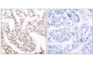 Immunohistochemical analysis of paraffin-embedded human breast carcinoma tissue using Elk-1 (phospho-Thr417) antibody (E011038). (ELK1 抗体  (pThr417))