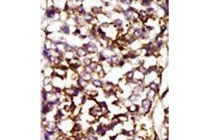 Formalin-fixed and paraffin-embedded human cancer tissue reacted with the primary antibody, which was peroxidase-conjugated to the secondary antibody, followed by AEC staining. (CDK4 抗体  (C-Term))