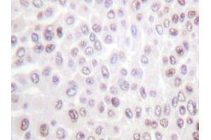 Immunohistochemistry analyzes of Histone H2B antibody in paraffin-embedded human breast carcinoma tissue. (Histone H2B 抗体)