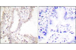 Immunohistochemical analysis of paraffin-embedded human lung carcinoma tissue using Prostate Apoptosis Response Protein-4 antibody. (PAWR 抗体)