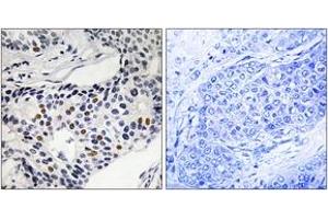 Immunohistochemistry analysis of paraffin-embedded human breast carcinoma, using WEE1 (Phospho-Ser53) Antibody. (WEE1 抗体  (pSer53))