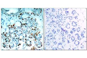 Immunohistochemical analysis of paraffin-embedded human breast carcinoma tissue, using BIM (phospho-Ser65) antibody (E011288). (BIM 抗体  (pSer65, pSer69))