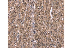 Immunohistochemistry of Human gastric cancer using HRH1 Polyclonal Antibody at dilution of 1:40 (HRH1 抗体)