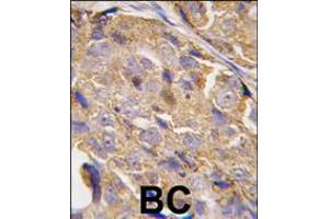 Formalin-fixed and paraffin-embedded human breast carcinoma tissue reacted with EIF4B-S422, which was peroxidase-conjugated to the secondary antibody, followed by DAB staining. (EIF4B 抗体  (AA 400-429))