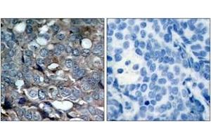Immunohistochemistry analysis of paraffin-embedded human breast carcinoma, using ASK1 (Phospho-Ser83) Antibody. (ASK1 抗体  (pSer83))