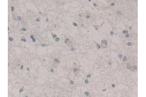 DAB staining on IHC-P; Samples: Human Glioma Tissue (Nestin 抗体  (AA 178-399))