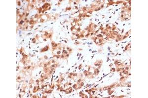 Immunohistochemistry of paraffin-embedded Human liver cancer using Phospho-STAT1(S727) Polyclonal Antibody at dilution of 1:100 (40x lens). (STAT1 抗体  (pSer727))