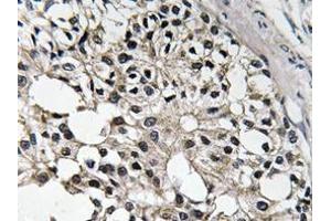 Immunohistochemistry analyzes of IRS-1 antibody in paraffin-embedded human breast carcinoma tissue. (IRS1 抗体)