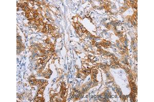 Immunohistochemistry of Human liver cancer using CA9 Polyclonal Antibody at dilution of 1:50 (CA9 抗体)