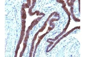 Formalin-fixed, paraffin-embedded human ovarian carcinoma stained with EpCAM antibody (EGP40/1110). (EpCAM 抗体  (Cytoplasmic Domain))