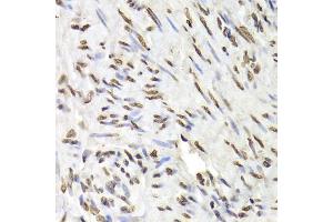 Immunohistochemistry of paraffin-embedded human adenomyosis using HNRNPD Antibody (ABIN5970929) at dilution of 1/100 (40x lens). (HNRNPD/AUF1 抗体)