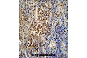 PUS3 antibody immunohistochemistry analysis in formalin fixed and paraffin embedded human lung carcinoma followed by peroxidase conjugation of the secondary antibody and DAB staining. (PUS3 抗体  (N-Term))