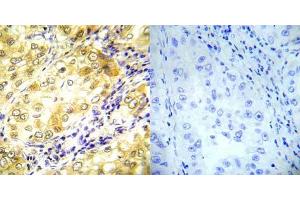 Immunohistochemical analysis of paraffin- embedded human lung carcinoma tissue using P53 (Ab-37) antibody (E022031). (p53 抗体)