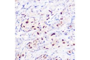 Immunohistochemistry of paraffin-embedded human breast cancer using [KO Validated] CDKN1A/p21CIP1 Rabbit pAb (ABIN1679159, ABIN1679158, ABIN3016472 and ABIN6219758) at dilution of 1:100 (40x lens). (p21 抗体  (AA 1-164))