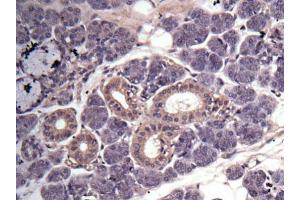 IHC-P Image Immunohistochemical analysis of human salivary gland cancer, using MMP3, antibody at 1:100 dilution. (MMP3 抗体  (N-Term))