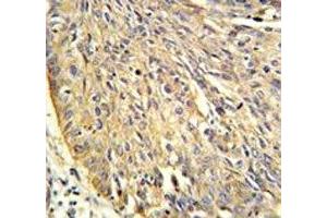 Annexin A1 antibody IHC analysis in formalin fixed and paraffin embedded human lung carcinoma. (Annexin a1 抗体  (AA 129-158))