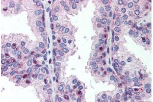 Human Prostate (formalin-fixed, paraffin-embedded) stained with MLF1IP antibody ABIN214310 at 10 ug/ml followed by biotinylated goat anti-rabbit IgG secondary antibody ABIN481713, alkaline phosphatase-streptavidin and chromogen. (MLF1IP 抗体  (pThr78))